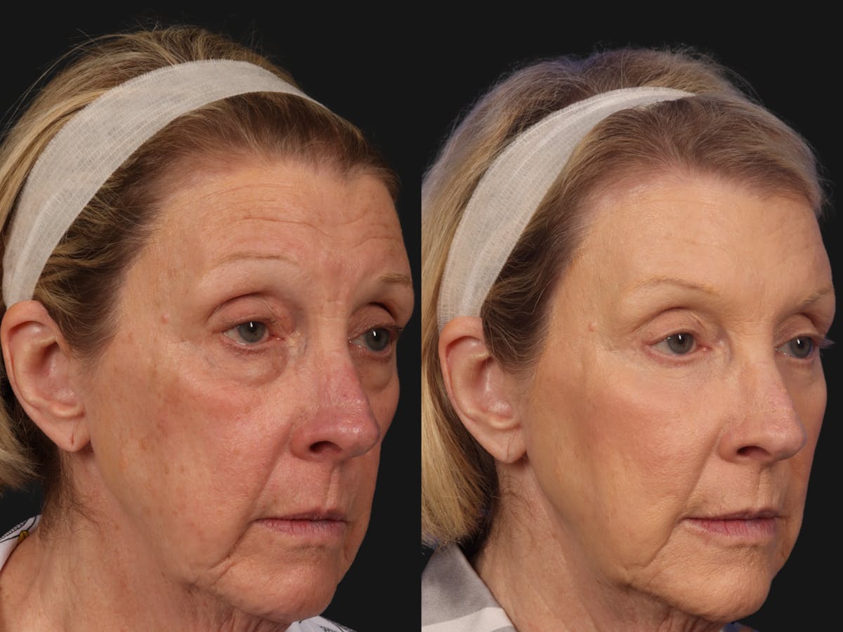 Mid Facelift Before & After Gallery - Patient 365785 - Image 3