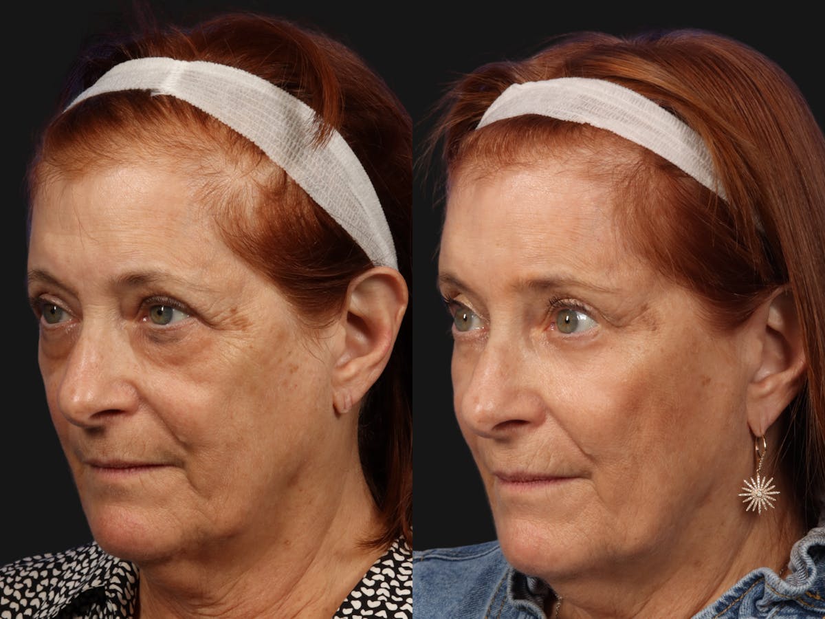 Mid Facelift Before & After Gallery - Patient 331192 - Image 2