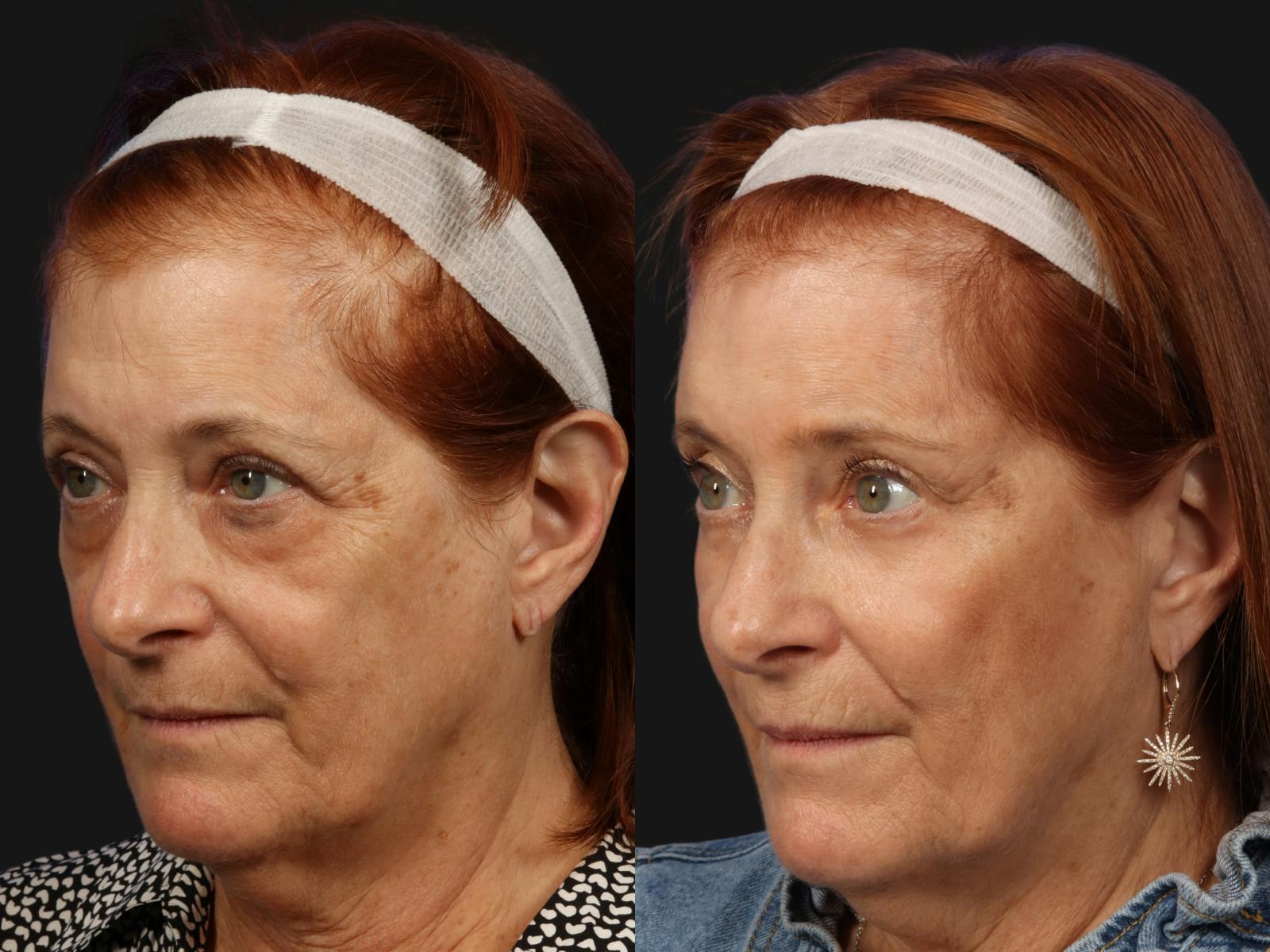 Mid Facelift Before & After Gallery - Patient 331192 - Image 2