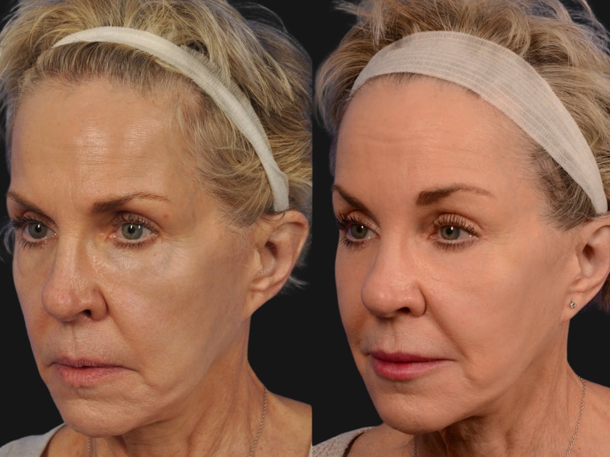 Mid Facelift Before & After Gallery - Patient 283809 - Image 2