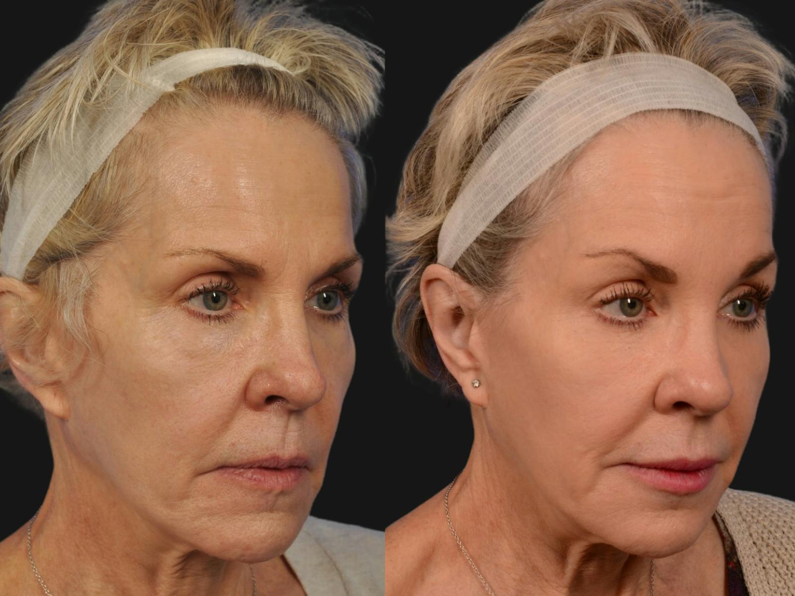 Mid Facelift Before & After Gallery - Patient 283809 - Image 3