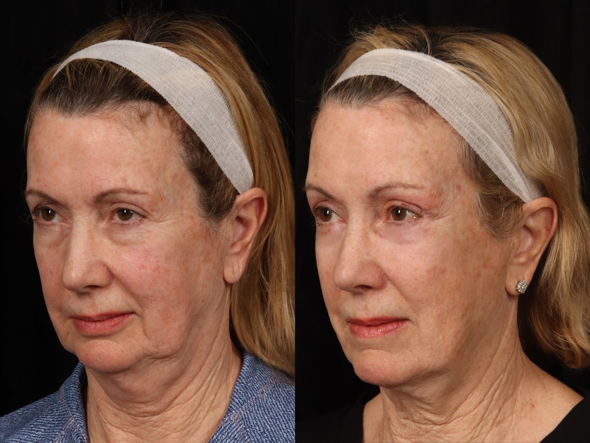 Mid Facelift Before & After Gallery - Patient 171269 - Image 3