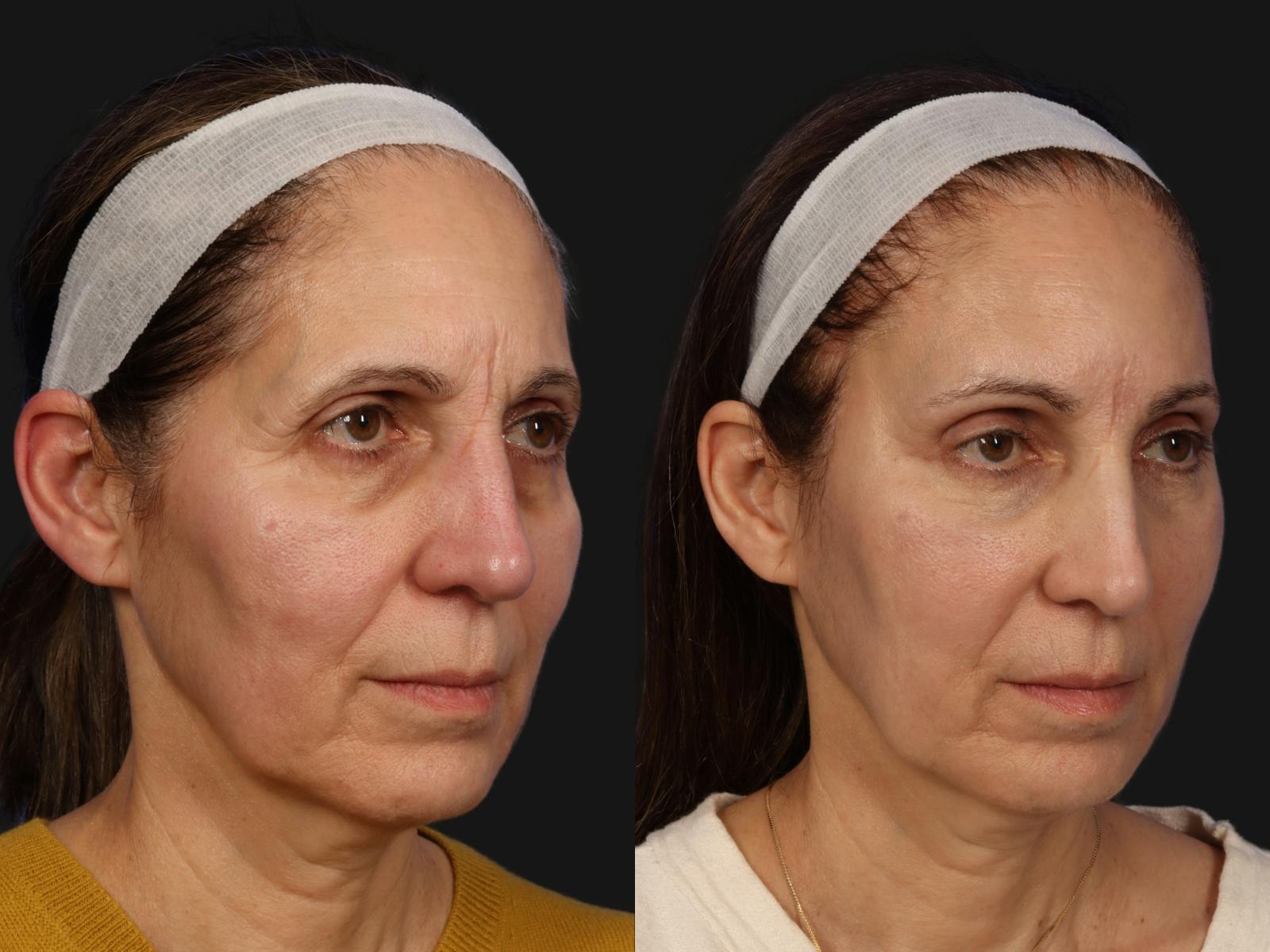 Mid Facelift Before & After Gallery - Patient 925564 - Image 2