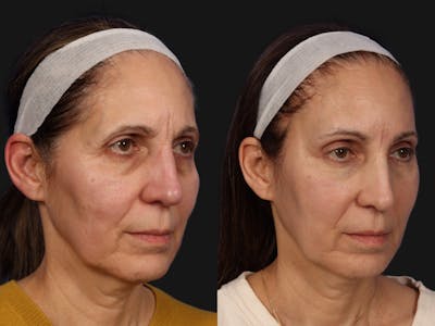 Mid Facelift Before & After Gallery - Patient 925564 - Image 2