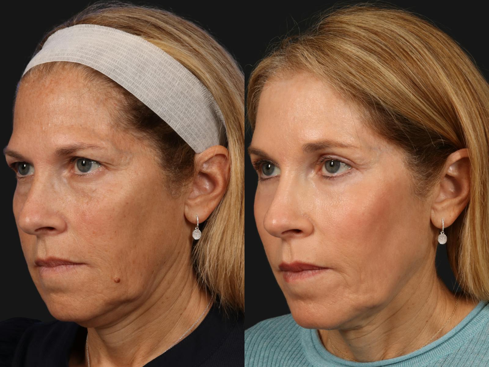 Liposculpture Before & After Gallery - Patient 421239 - Image 3