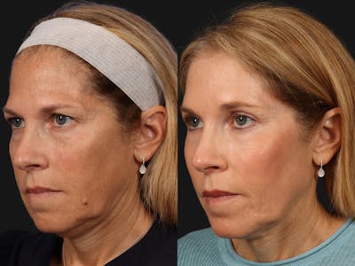 Liposculpture Before & After Gallery - Patient 421239 - Image 3