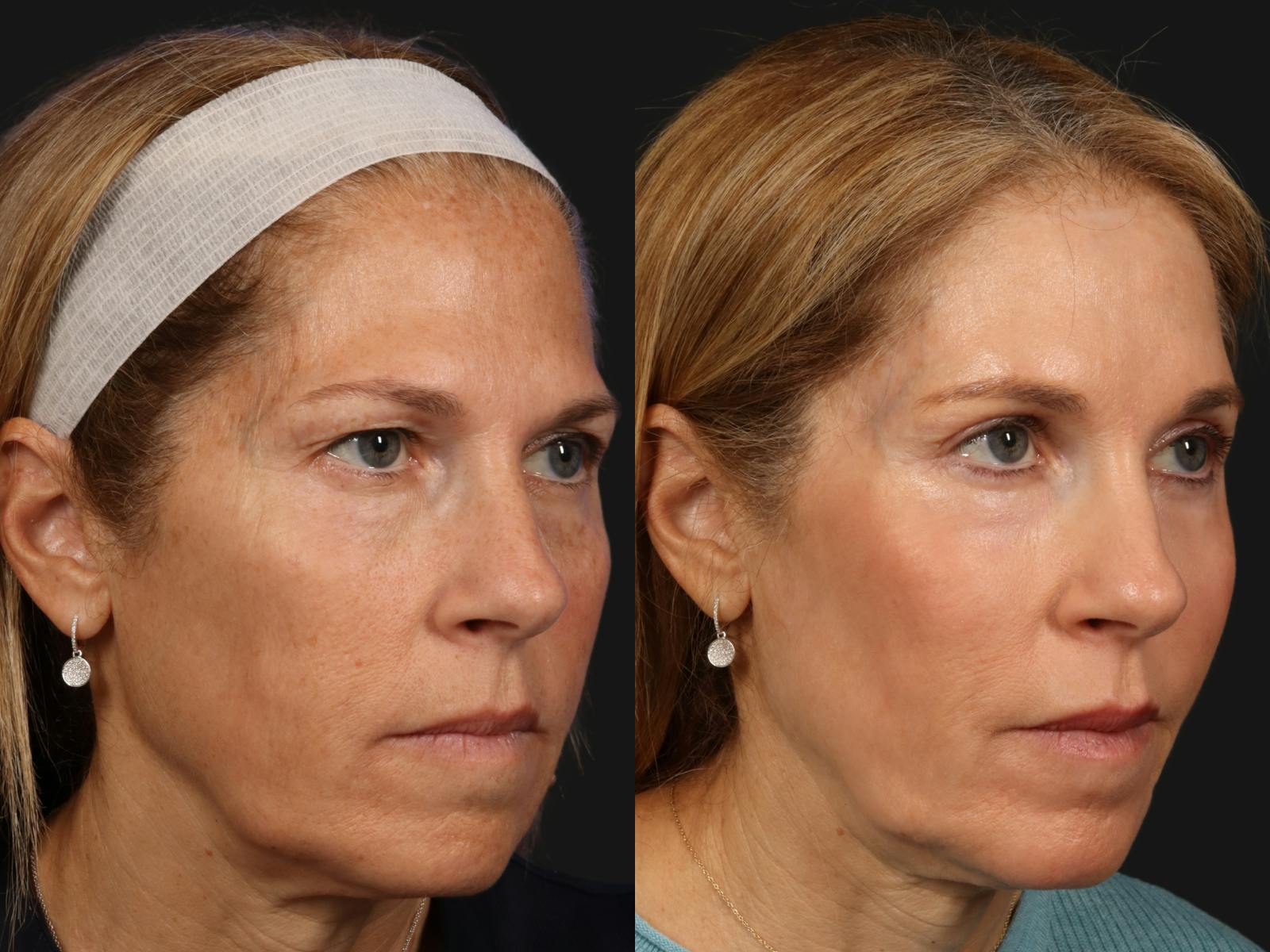 Liposculpture Before & After Gallery - Patient 421239 - Image 2