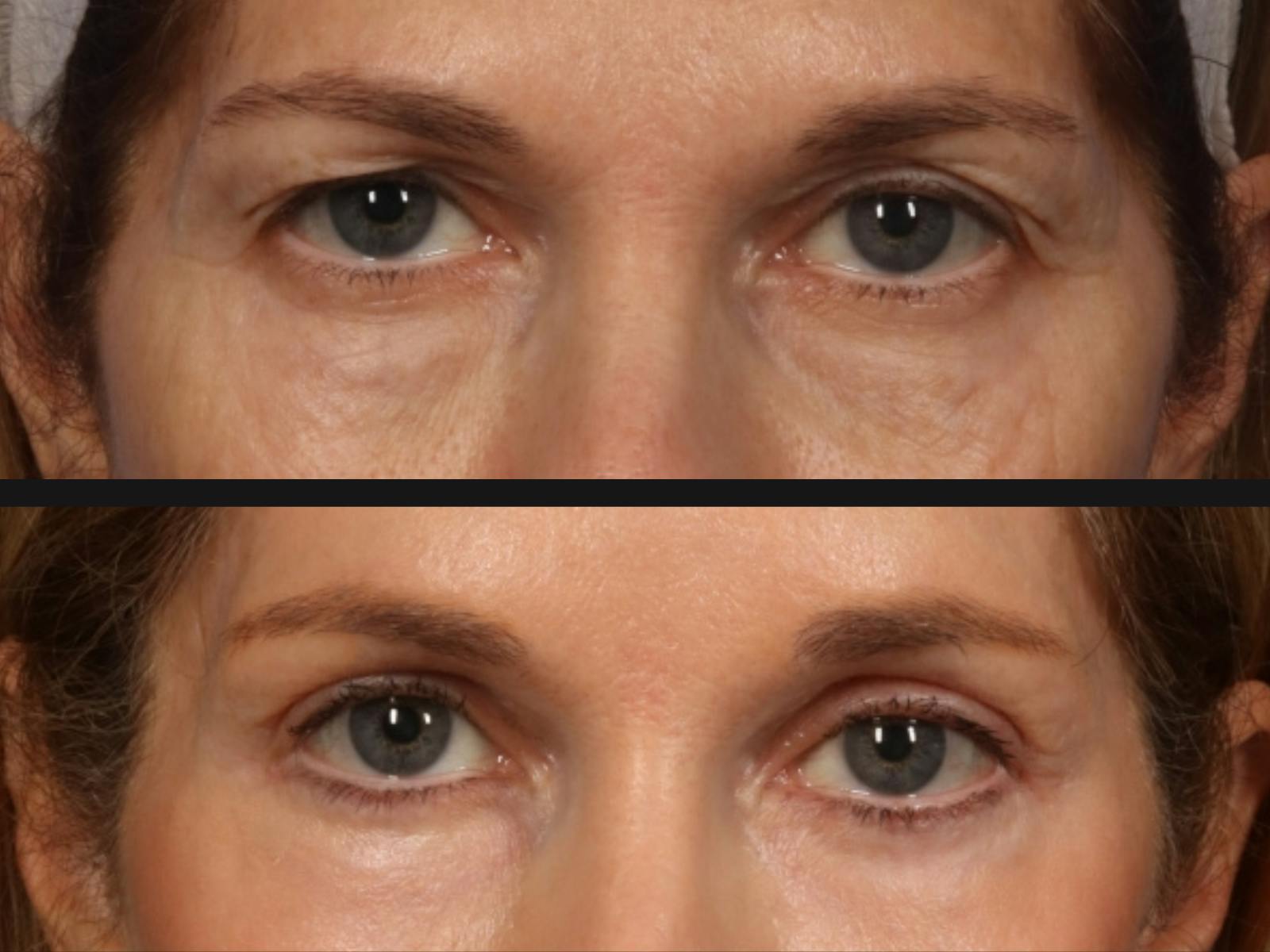 Blepharoplasty Before & After Gallery - Patient 357479 - Image 2