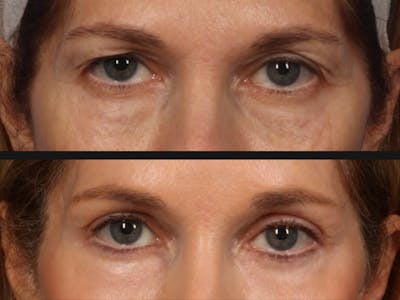 Blepharoplasty Before & After Gallery - Patient 357479 - Image 2