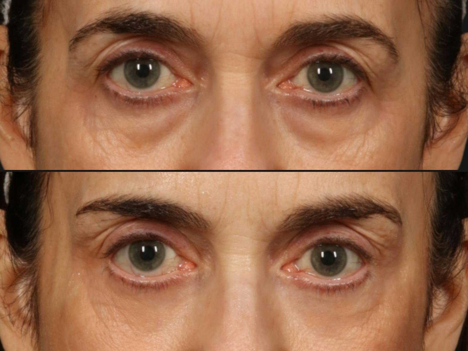 Laser Skin Resurfacing Before & After Gallery - Patient 187535 - Image 2