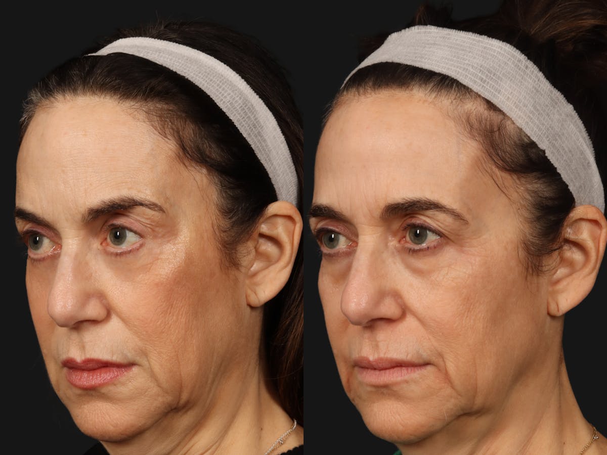Mid Facelift Before & After Gallery - Patient 203401 - Image 3