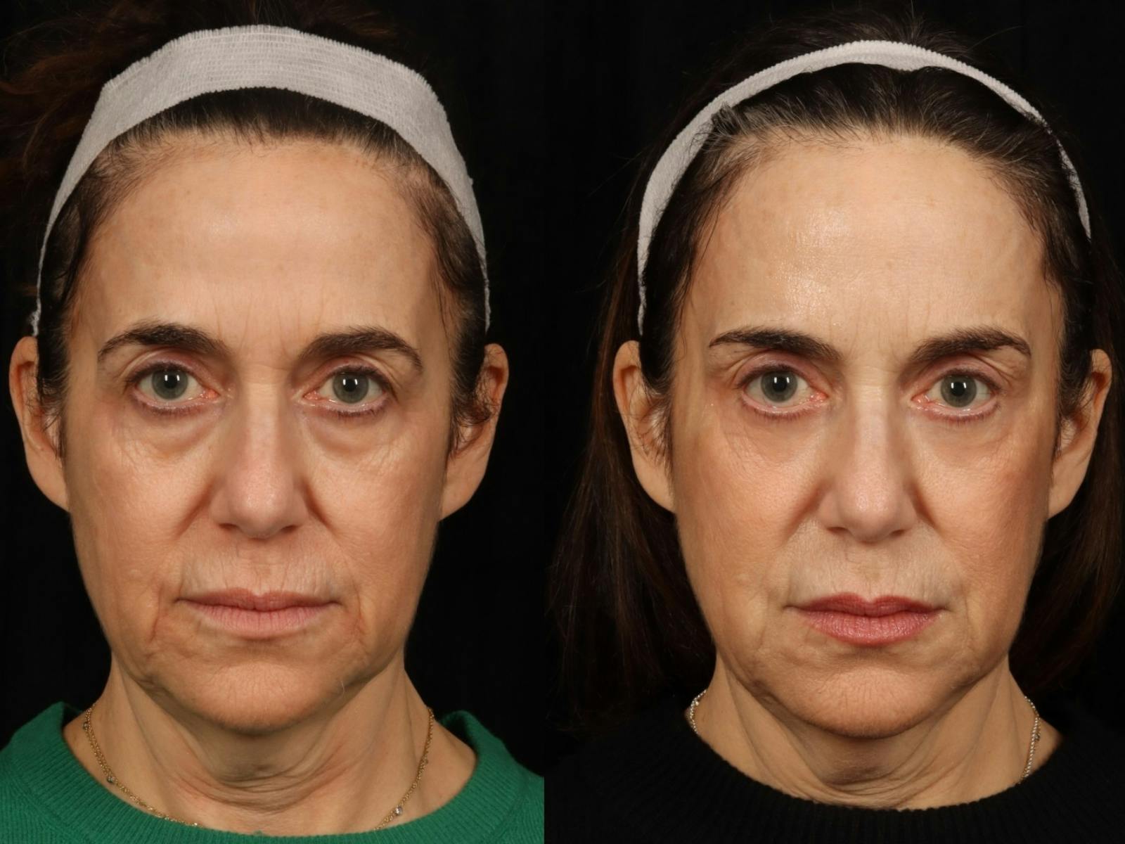 Laser Skin Resurfacing Before & After Gallery - Patient 187535 - Image 1