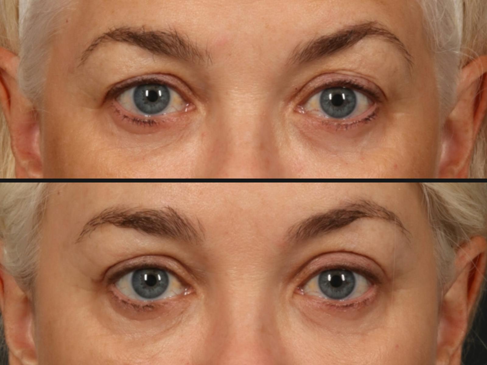 Brow Lift Before & After Gallery - Patient 258159 - Image 2