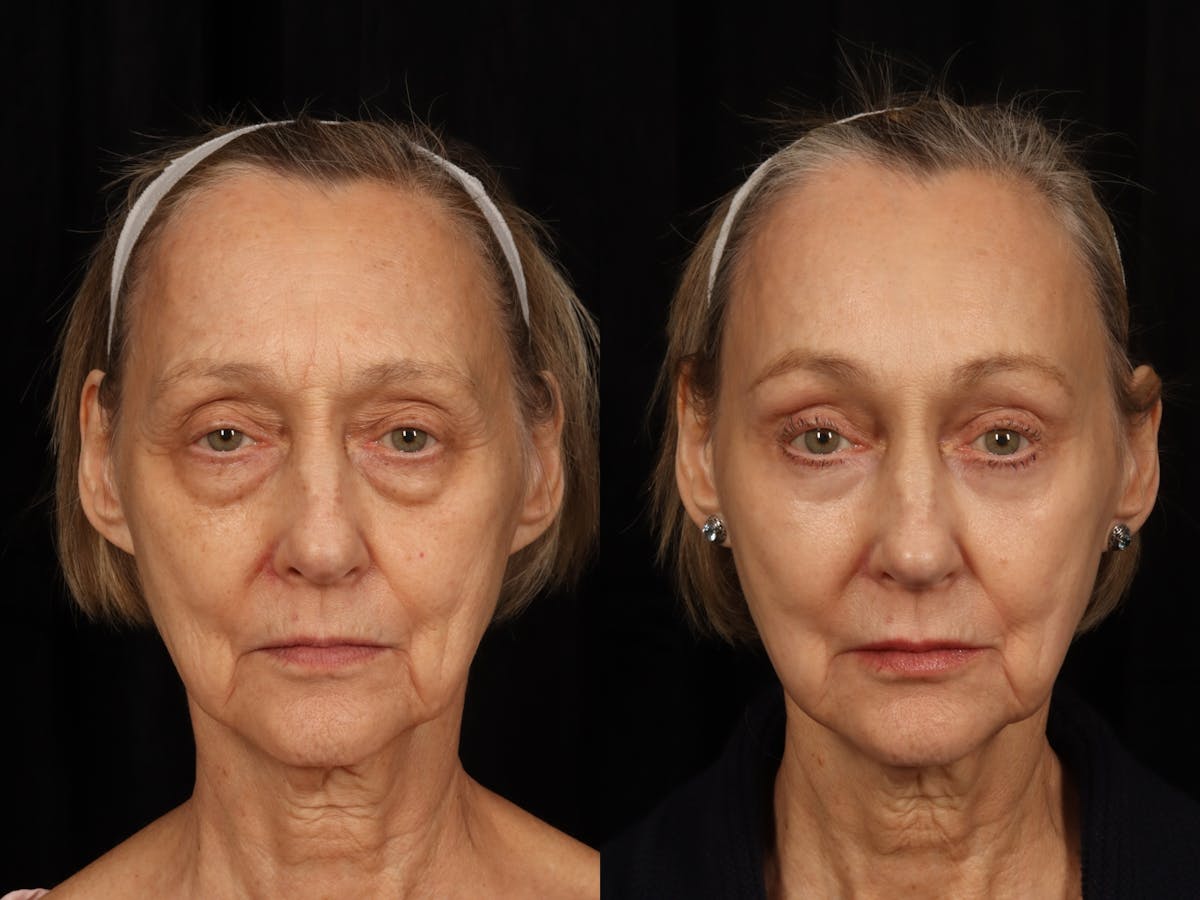 Liposculpture Before & After Gallery - Patient 703892 - Image 1