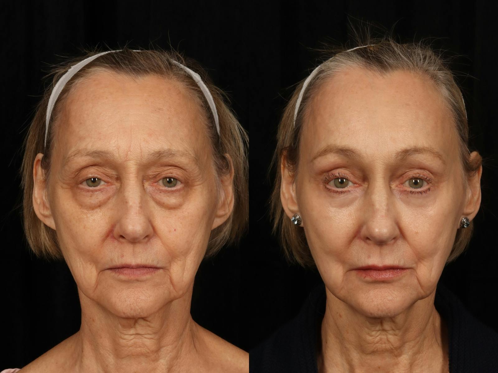 Liposculpture Before & After Gallery - Patient 703892 - Image 1