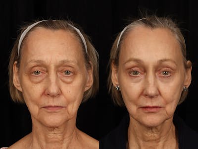 Mid Facelift Before & After Gallery - Patient 408893 - Image 1