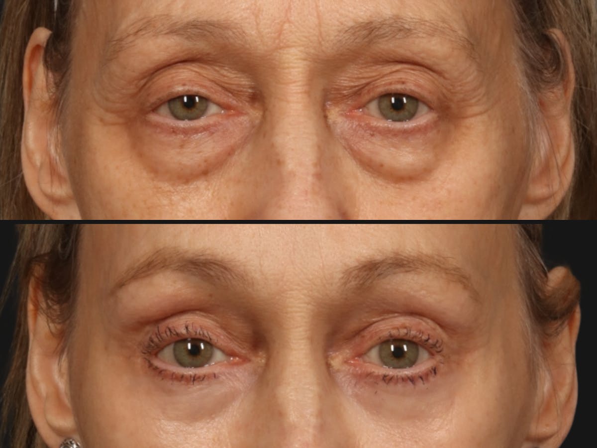 Blepharoplasty Before & After Gallery - Patient 256432 - Image 2
