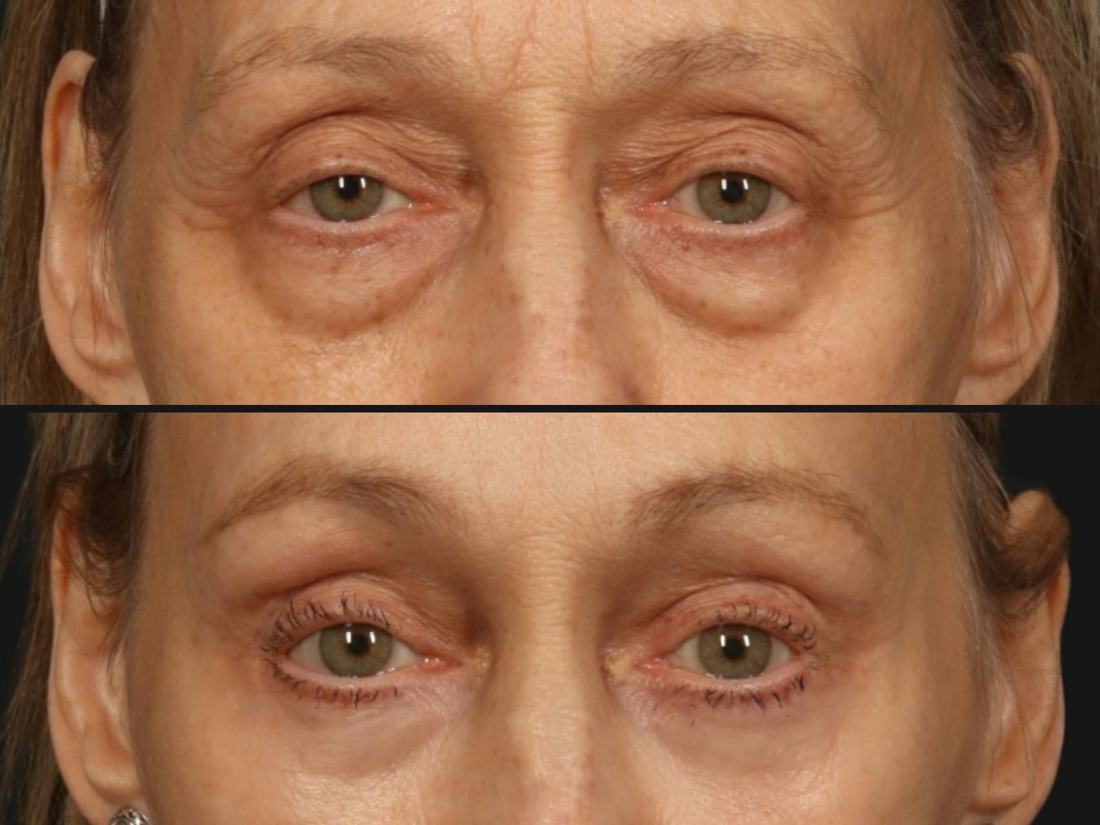 Blepharoplasty Before & After Gallery - Patient 256432 - Image 2
