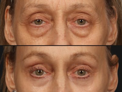 Blepharoplasty Before & After Gallery - Patient 256432 - Image 2