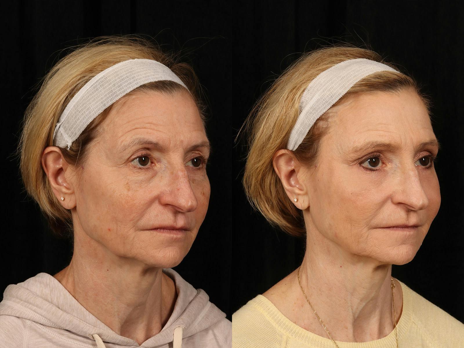 Liposculpture Before & After Gallery - Patient 469382 - Image 2