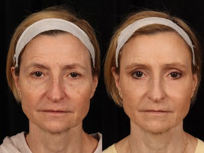 Liposculpture Before & After Gallery - Patient 469382 - Image 1