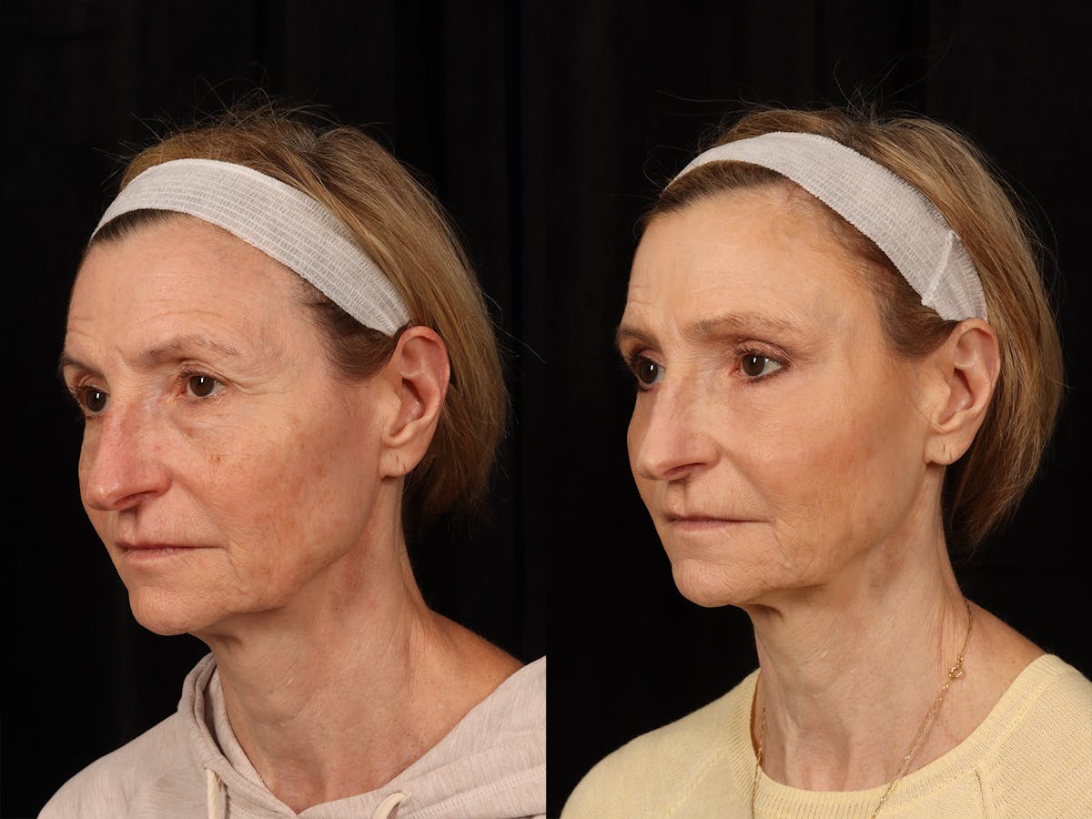Liposculpture Before & After Gallery - Patient 469382 - Image 3