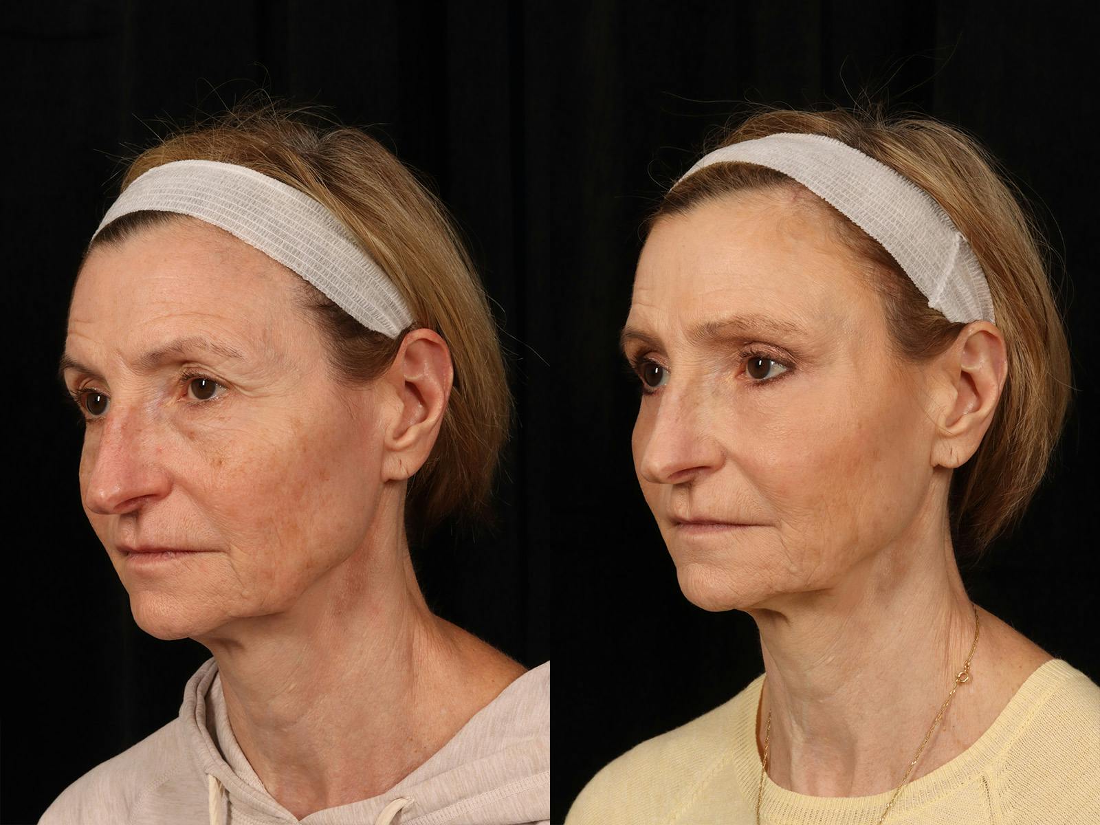 Liposculpture Before & After Gallery - Patient 469382 - Image 3