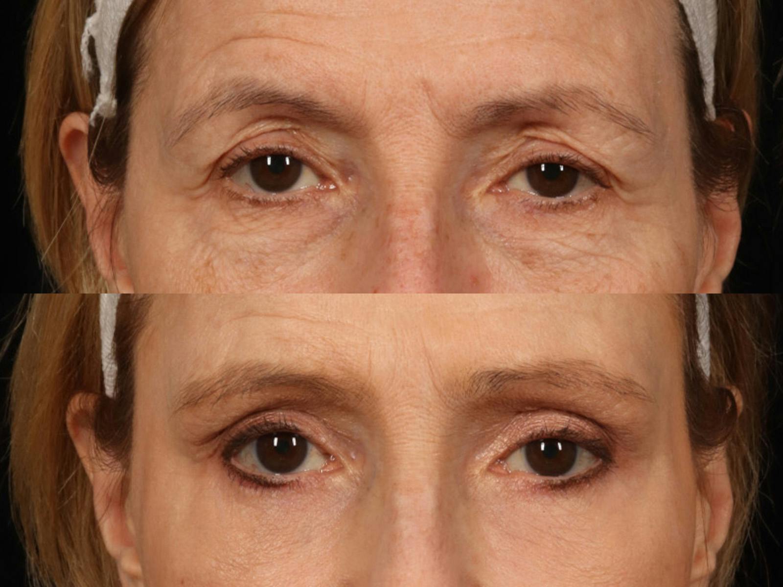 Liposculpture Before & After Gallery - Patient 469382 - Image 4