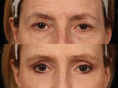 Festoon Surgery Before & After Gallery - Patient 302872 - Image 2