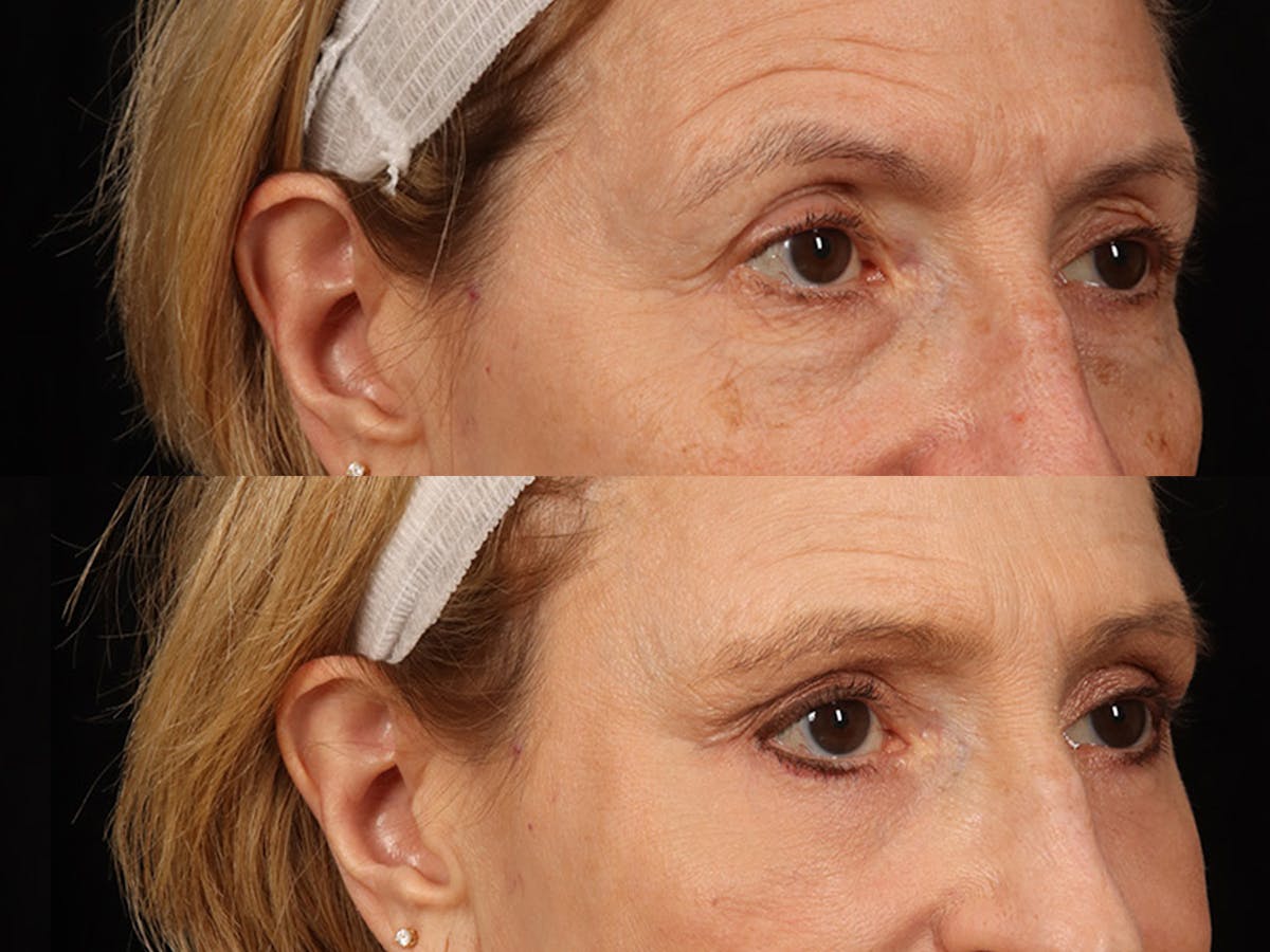 Liposculpture Before & After Gallery - Patient 469382 - Image 5