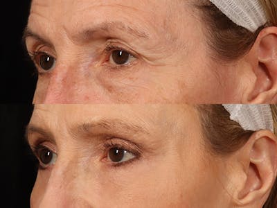 Mid Facelift Before & After Gallery - Patient 109857 - Image 6