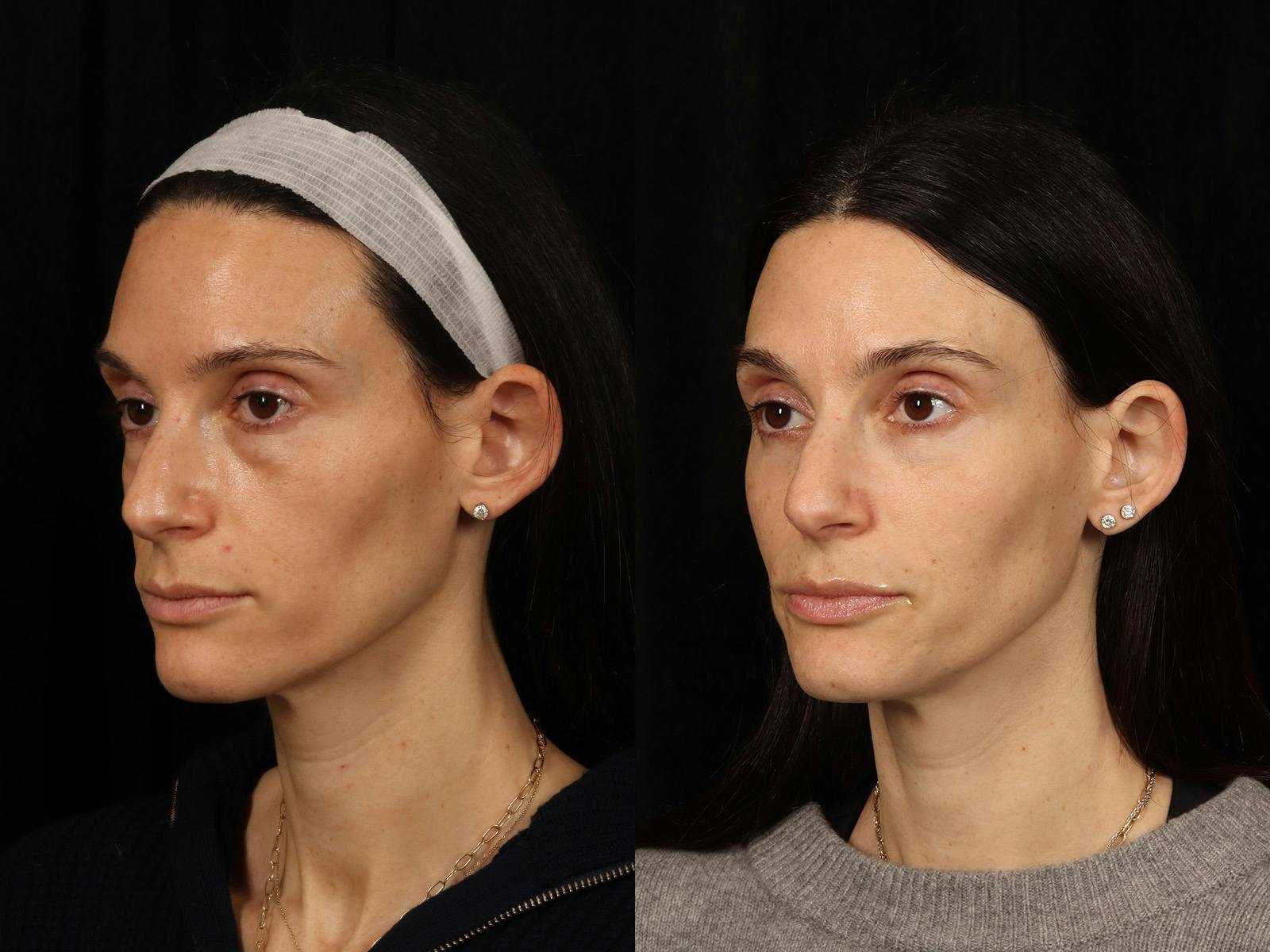 Festoon Surgery Before & After Gallery - Patient 356624 - Image 3