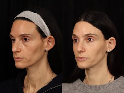 Laser Skin Resurfacing Before & After Gallery - Patient 647447 - Image 3