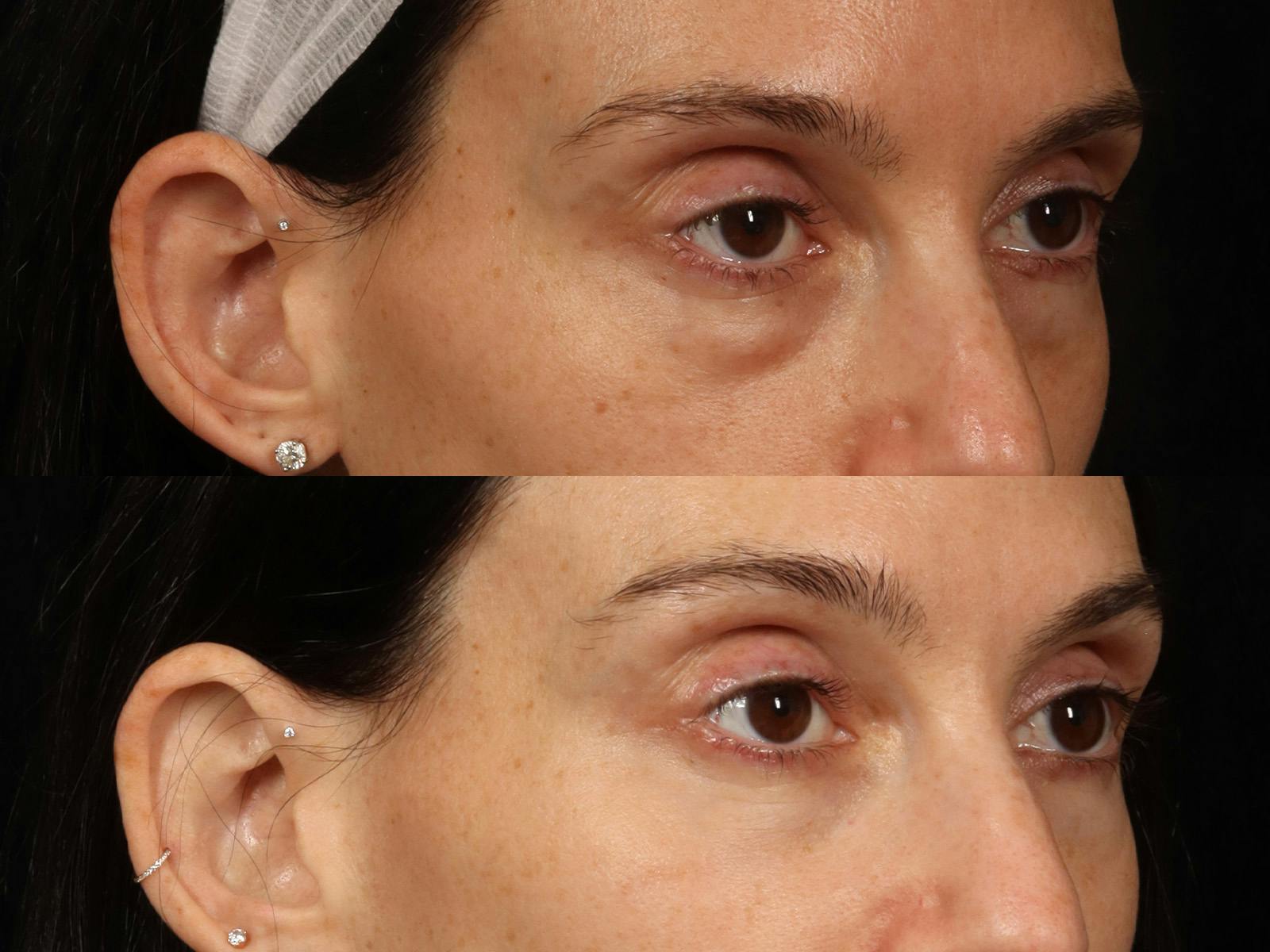 Festoon Surgery Before & After Gallery - Patient 356624 - Image 5