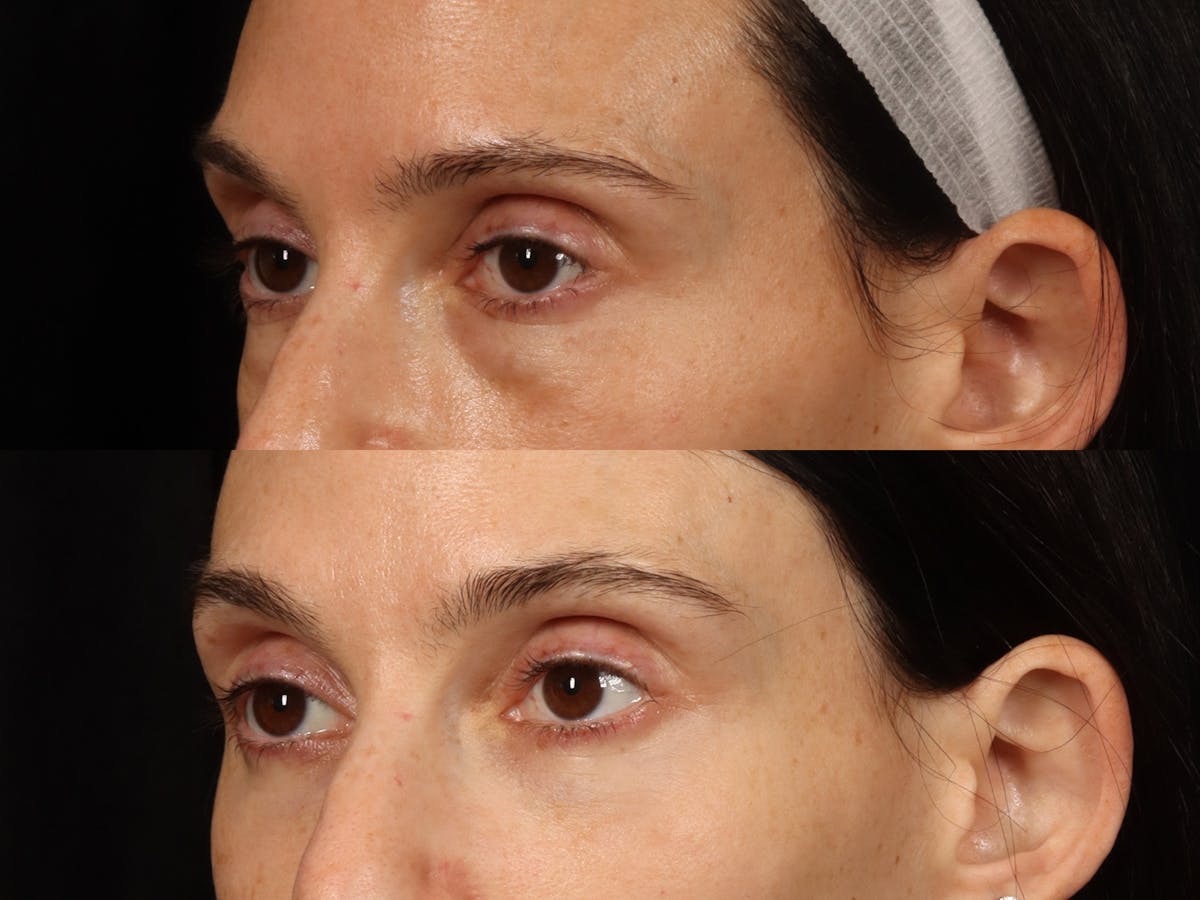 Festoon Surgery Before & After Gallery - Patient 356624 - Image 6