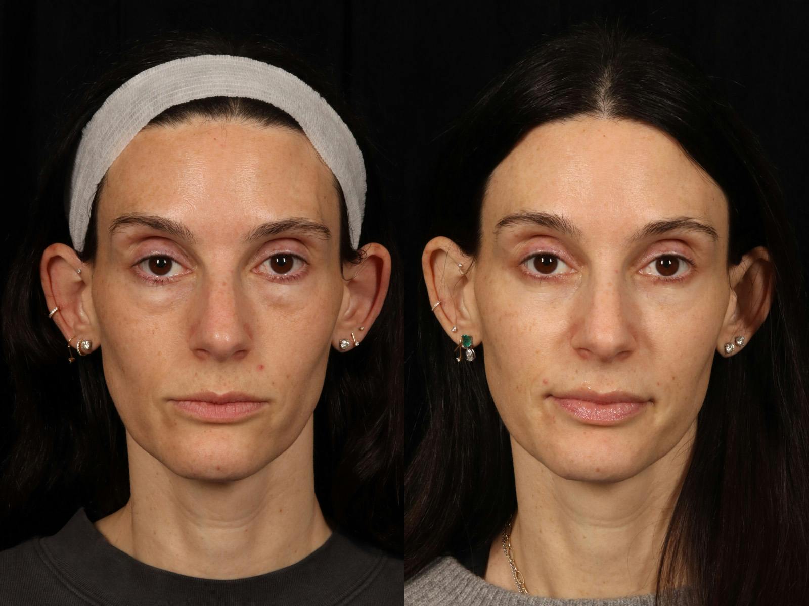 Festoon Surgery Before & After Gallery - Patient 356624 - Image 1