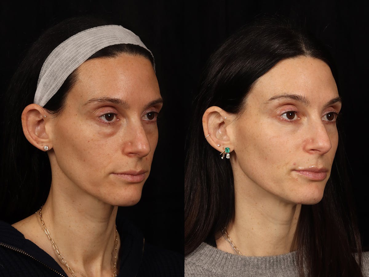 Festoon Surgery Before & After Gallery - Patient 356624 - Image 2