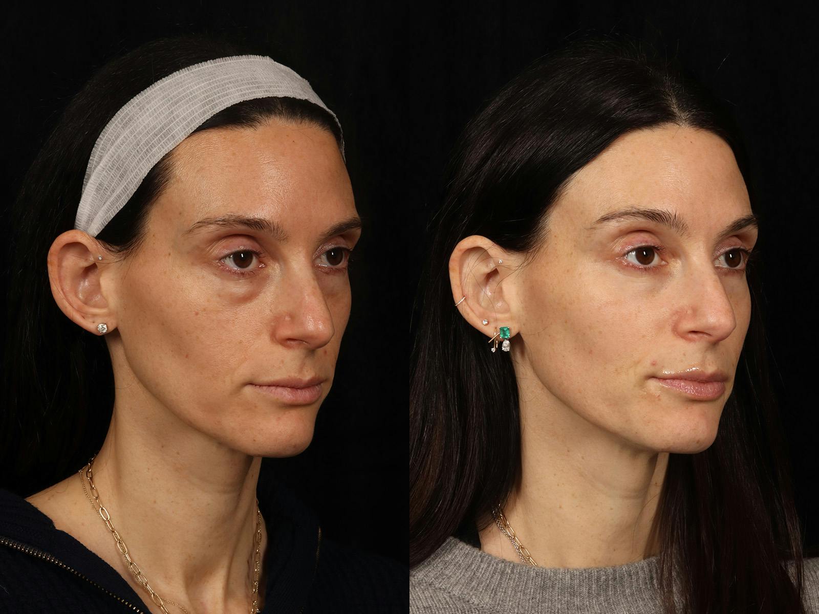 Festoon Surgery Before & After Gallery - Patient 356624 - Image 2