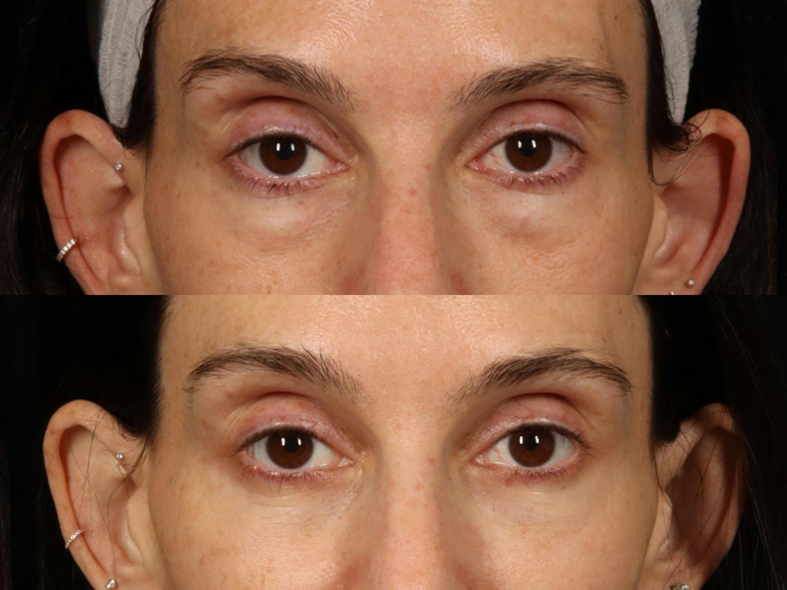 Festoon Surgery Before & After Gallery - Patient 356624 - Image 4