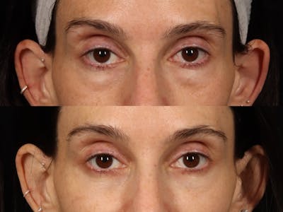 Festoon Surgery Before & After Gallery - Patient 356624 - Image 2