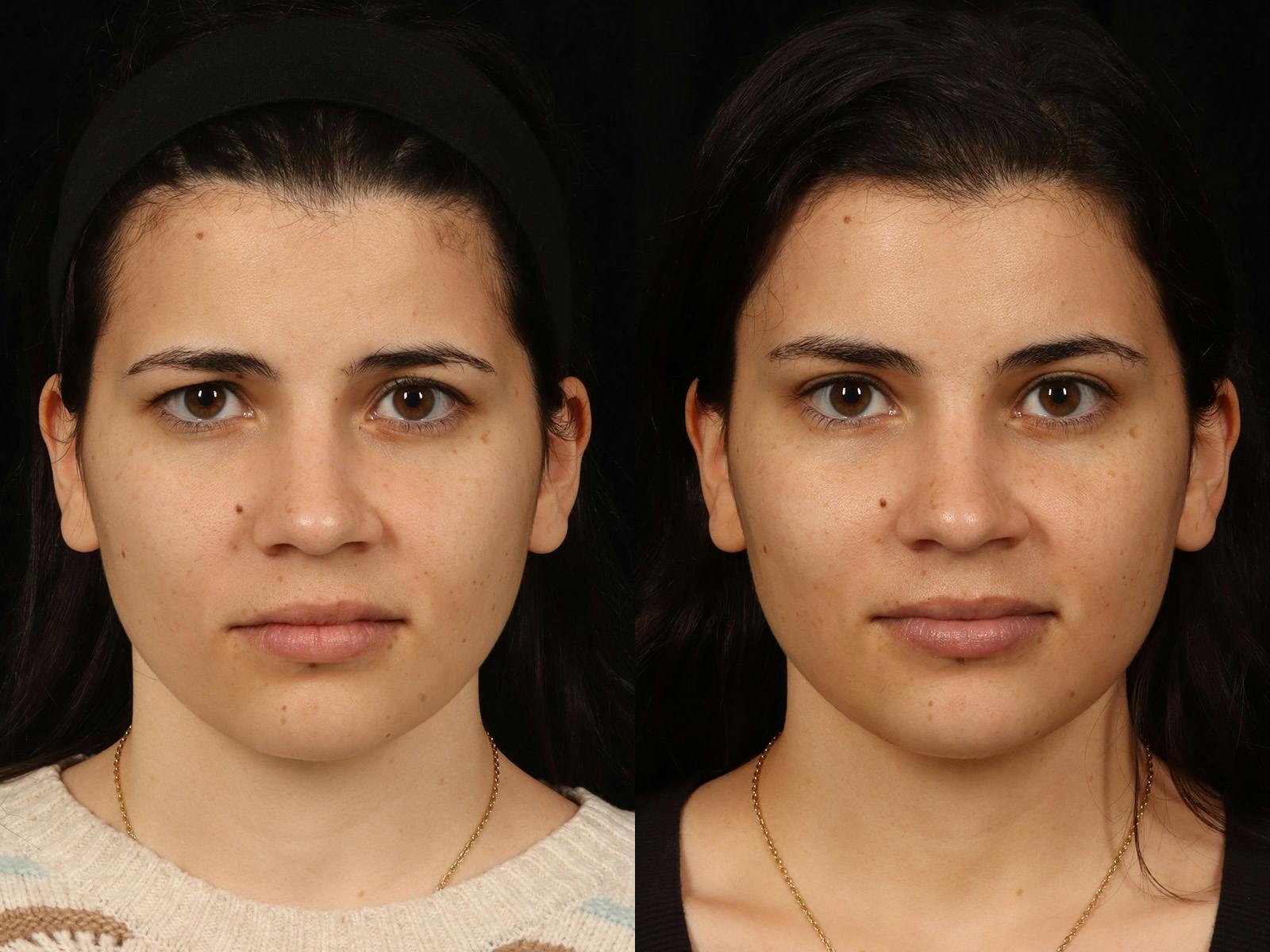 Blepharoplasty Before & After Gallery - Patient 535690 - Image 1