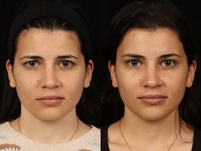 Blepharoplasty Before & After Gallery - Patient 535690 - Image 1