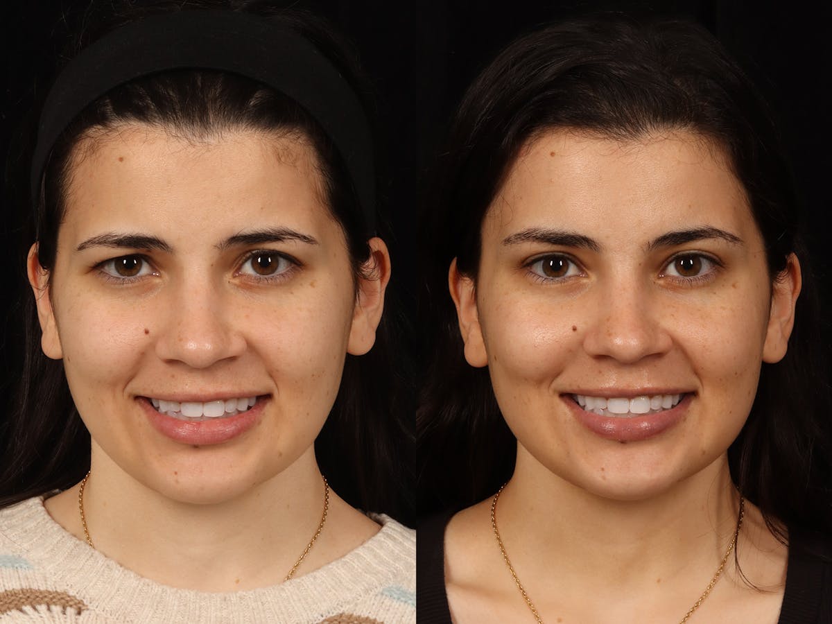 Blepharoplasty Before & After Gallery - Patient 535690 - Image 3