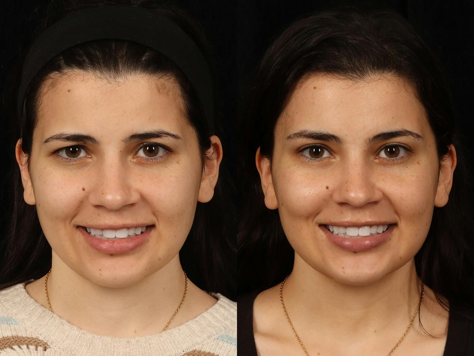 Blepharoplasty Before & After Gallery - Patient 535690 - Image 3