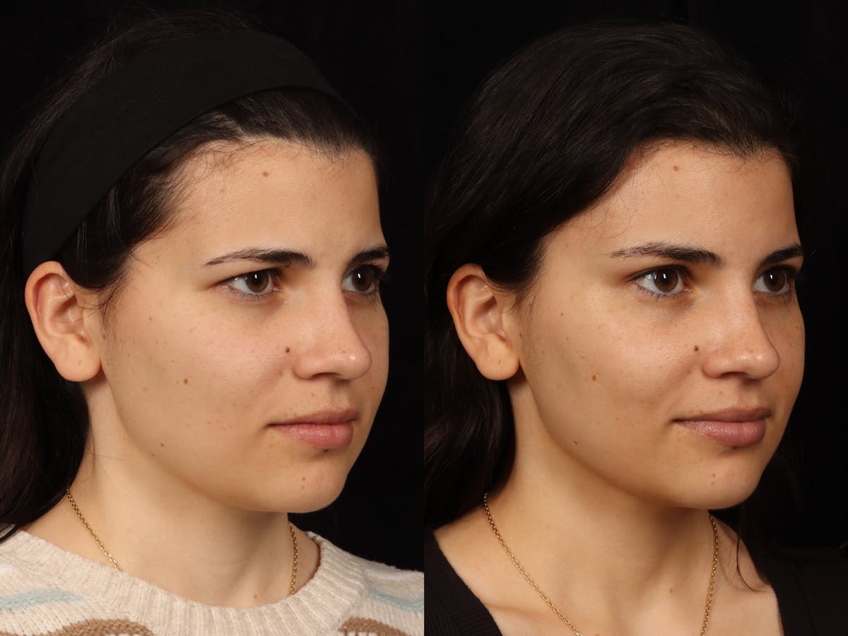 Blepharoplasty Before & After Gallery - Patient 535690 - Image 5
