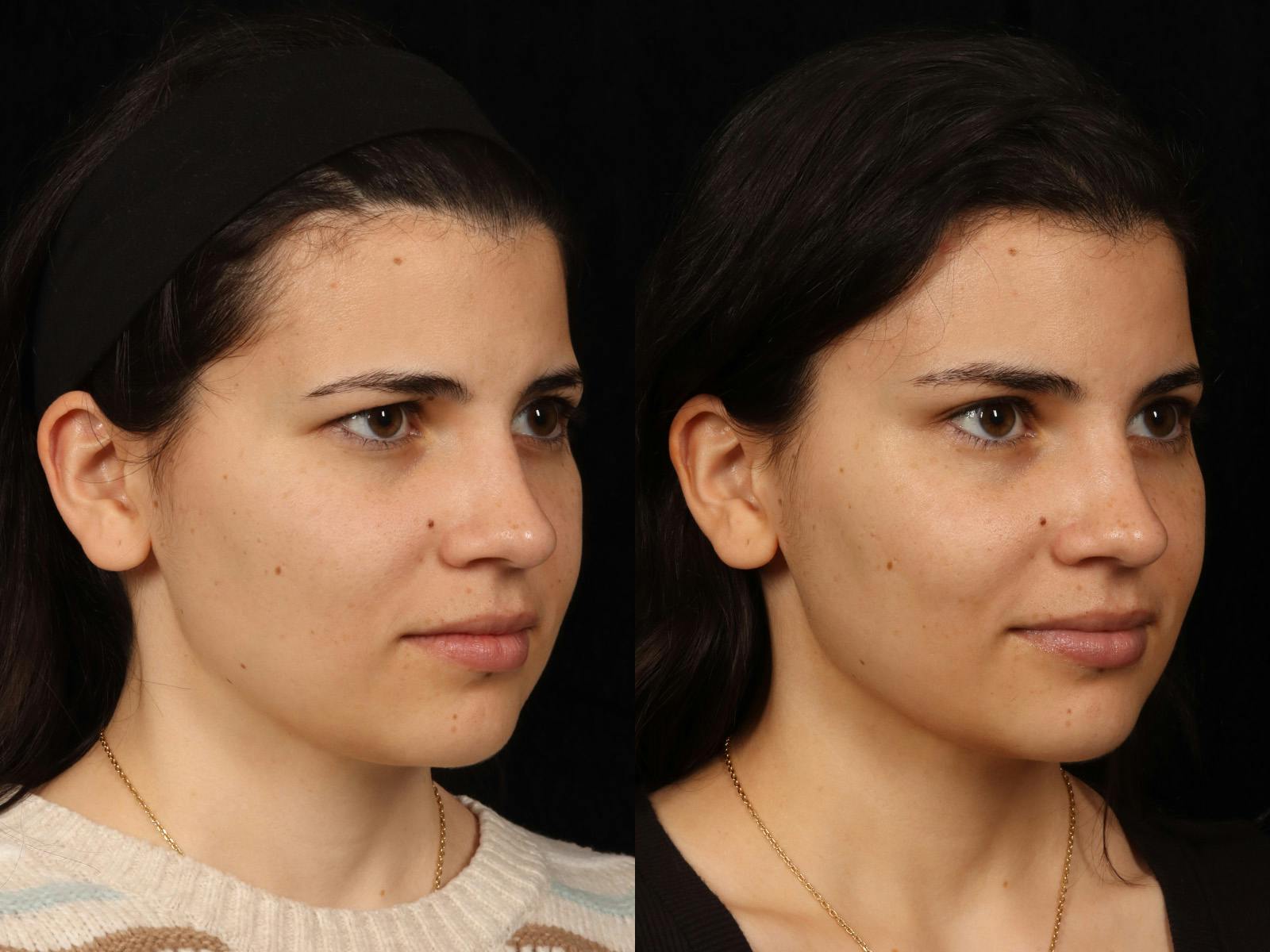 Blepharoplasty Before & After Gallery - Patient 535690 - Image 5