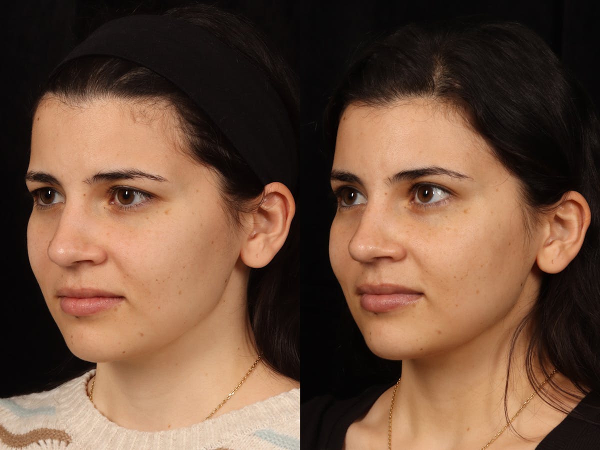 Blepharoplasty Before & After Gallery - Patient 535690 - Image 7
