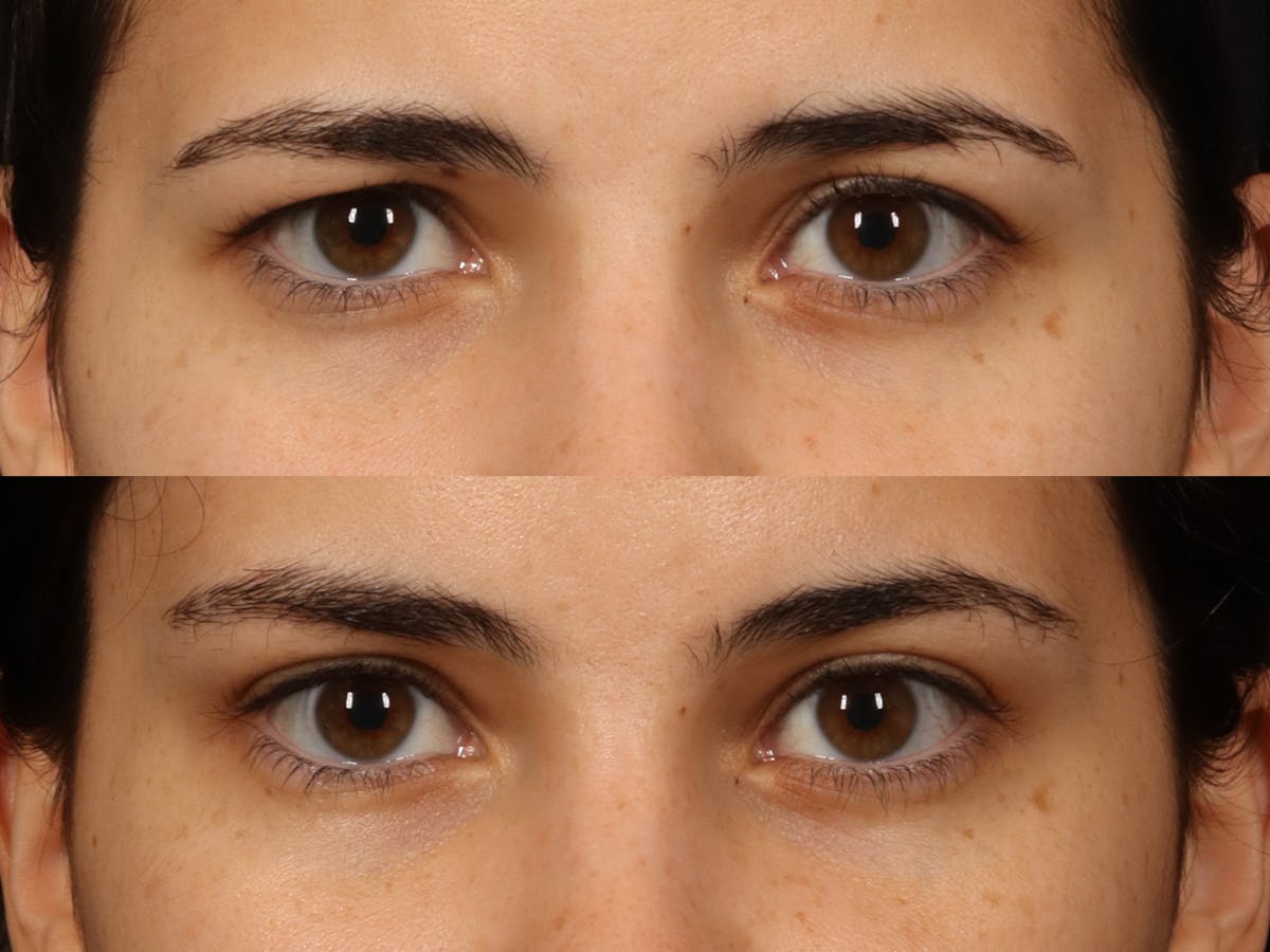 Blepharoplasty Before & After Gallery - Patient 535690 - Image 2