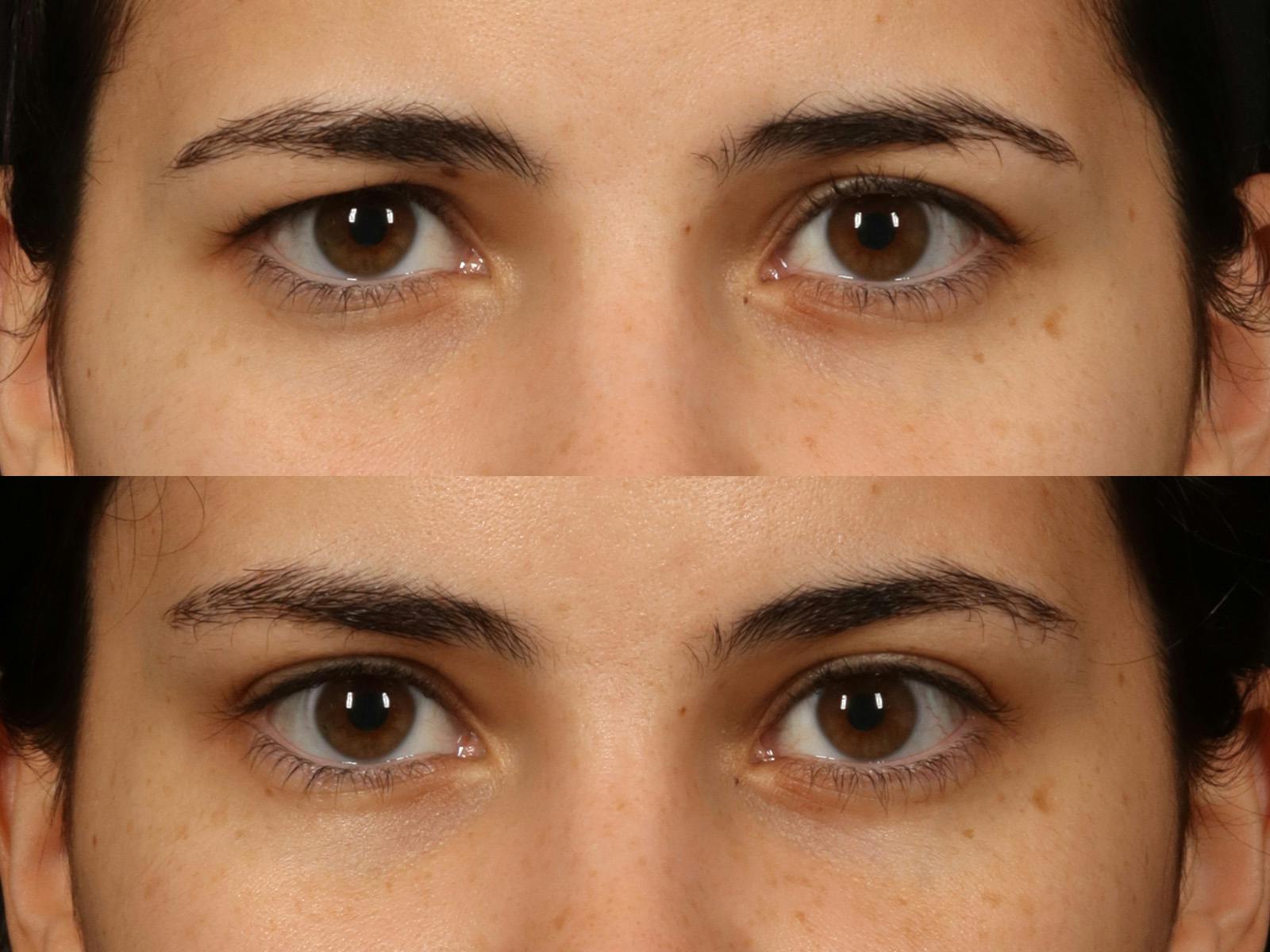 Blepharoplasty Before & After Gallery - Patient 535690 - Image 2