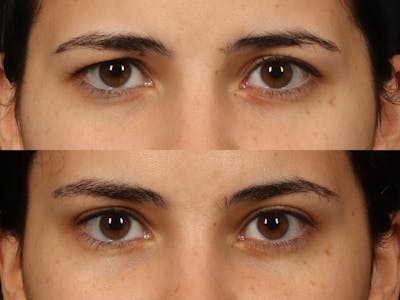 Blepharoplasty Before & After Gallery - Patient 535690 - Image 2